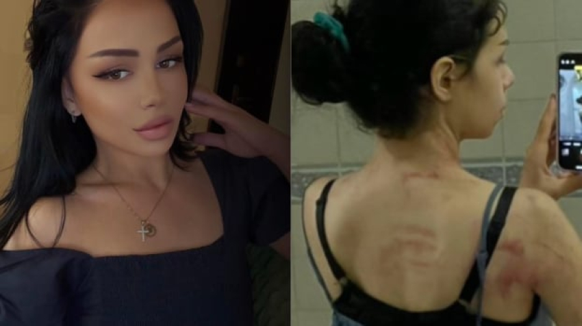 «Հարգեք ու սիրեք ինքներդ ձեզ». Մարի Պետրոսյանը կիսվել է մարմնի վրա բռնության հետքերով ու նշել, որ ամուսնալուծվել է